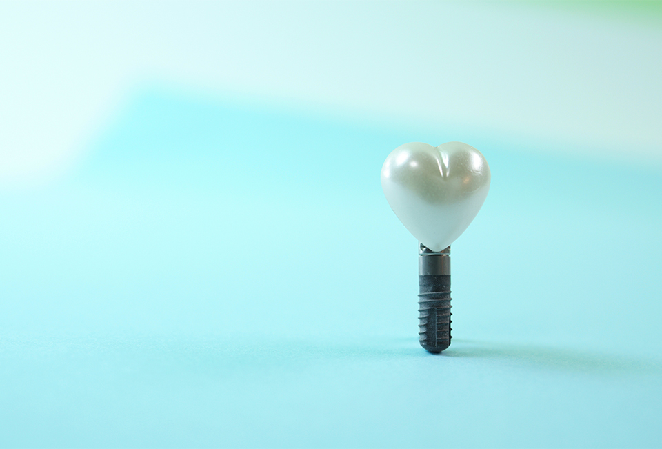 西京区上桂駅・ほんだ歯科クリニック・ほんだ歯科クリニックのインプラント治療