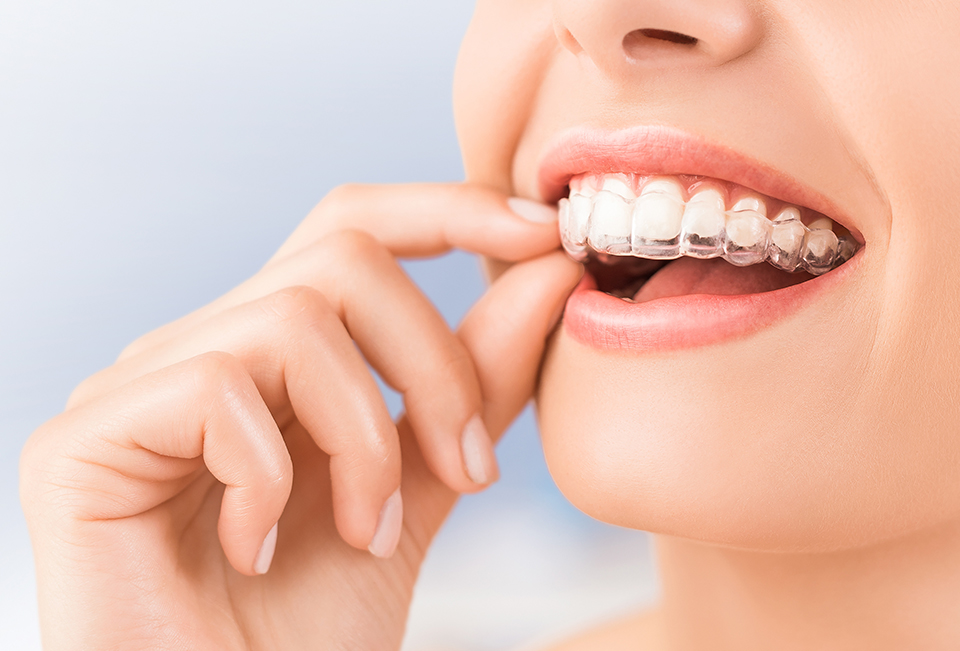 西京区上桂駅・ほんだ歯科クリニック・透明で目立ちにくいマウスピース矯正